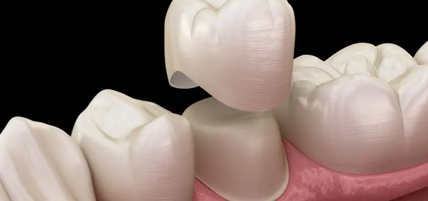 couronne dentaire pour des dents abîmées